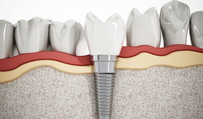 Types of Dental Implants: Which One Is Right for You?