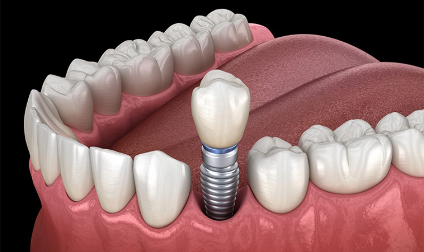 what problems can occur after dental implant surgery
