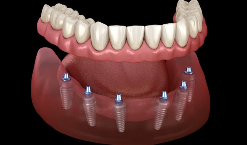 All You Want to Know about the All-On-4 Dental System